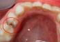 Причины, лечение и профилактика кариеса молочных зубов у детей