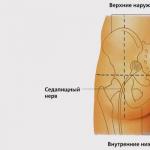 Как сделать укол в ягодицу